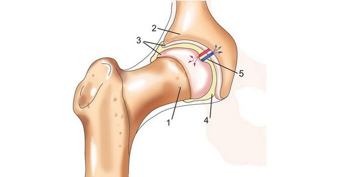 άρθρωση ισχίου και αρθροπάθεια